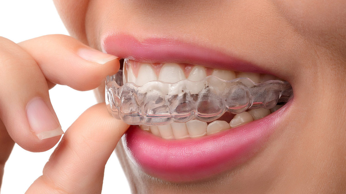 Invisalign-unsichtbare-zahnspange-3