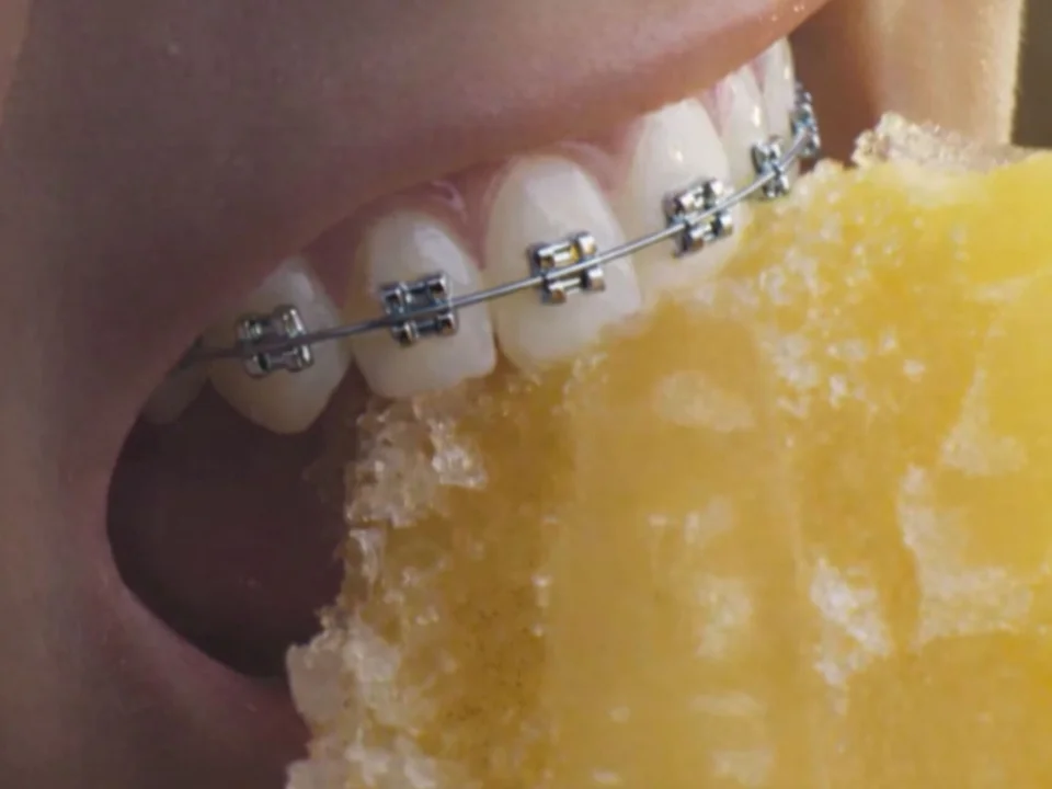 Kann Ich Mit Einer Spange Normal Essen