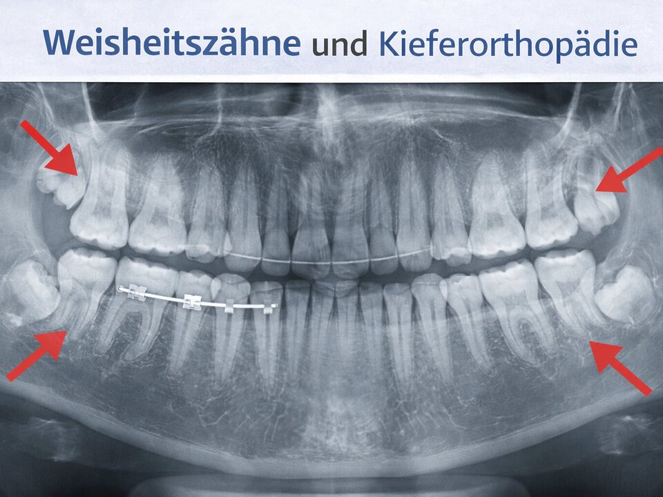 Weisheitszähne Und Kieferorthopädie