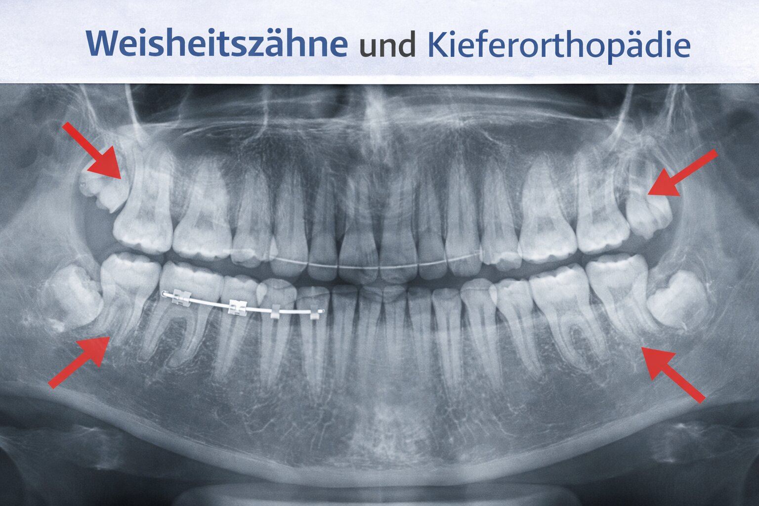 Weisheitsz hne Und Kieferorthop die Alles Wichtige