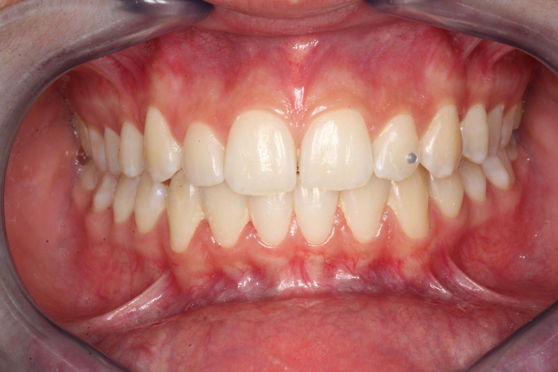 Intraoral Biss Frontal